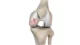 osteochondritis