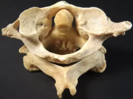 Vertebra   atlas axis superior