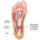 fasciite plantaire