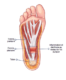 fasciite plantaire