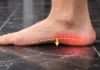 Understanding Acquired Flatfoot in Adults
