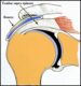 Conflit-sous-acromial-1