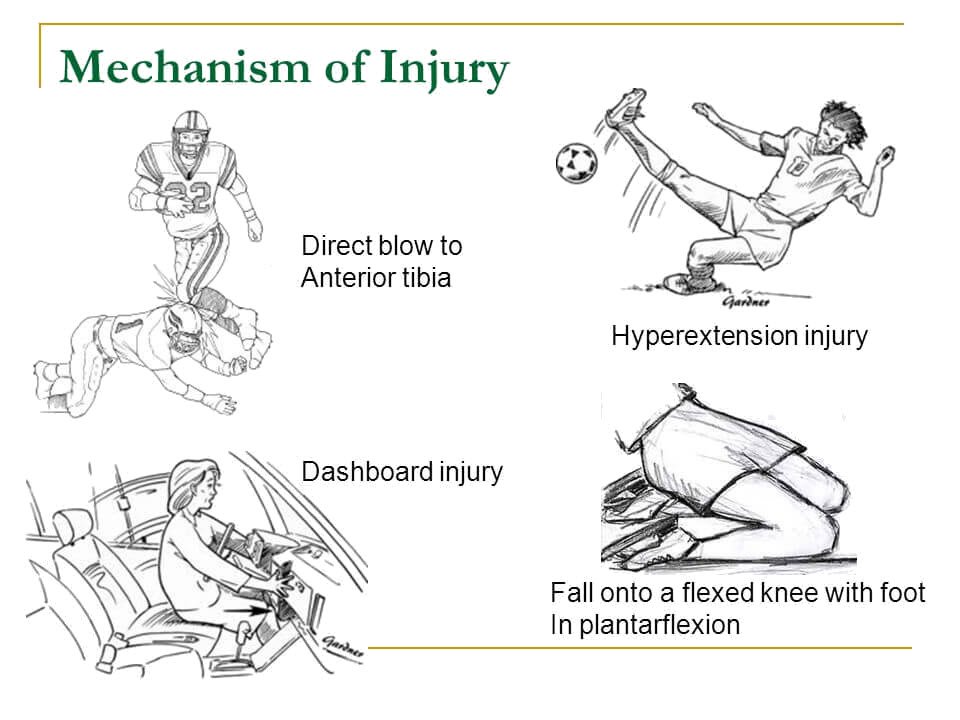 Mécanisme de lésion du ligament croisé postérieur