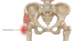 Trochanteric bursitis