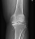 knee joint osteoarthritis