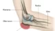olecranion bursitis