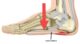 plantar fasciitis1