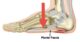 plantare fasciitis