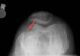 radiography-chondromalacia
