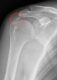 Calcific tendinitis marked