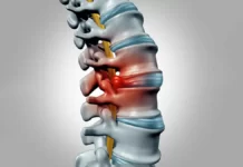 Cervical Myelopathy