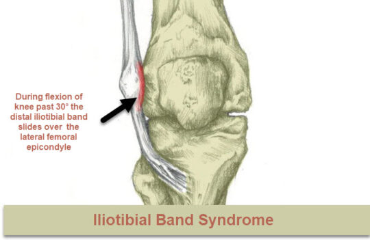 Iliotibial band syndrome (ITBS) of the knee | OsteoMag