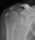 calcific tendinosis of supraspinatus tendon 1