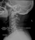cervical-degenerative-spondylosis-fr