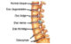 cervical-spondylosis-1