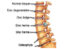 cervical spondylosis