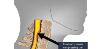 cervical stenosis 1 1