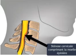 cervical stenosis  fr