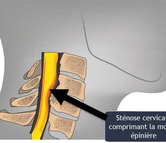 cervical stenosis  fr