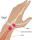 de  quervain  tenosynovitis fr