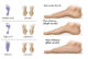 foot deformities
