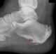 heel-spur