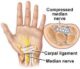 median nerve compression