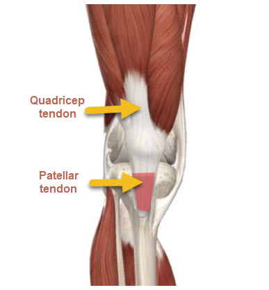 Patellar tendinopathy | OsteoMag