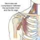 pectoral-minor-syndrome
