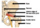 piriformis syndrome