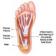 plantar-fasciatis