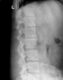 ankylosing spondylitis 9