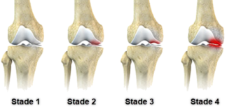 osteonecrosis1