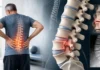 Spondylolisthésis lombaire : causes, symptômes, diagnostic et traitement Spondylolisthésis lombaire : causes, symptômes, diagnostic et traitement