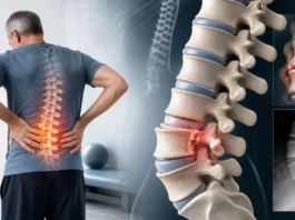 Spondylolisthésis lombaire : causes, symptômes, diagnostic et traitement