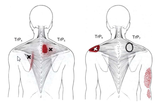 Treatment of Trapezius Trigger Points by Ischemic Compression: An ...