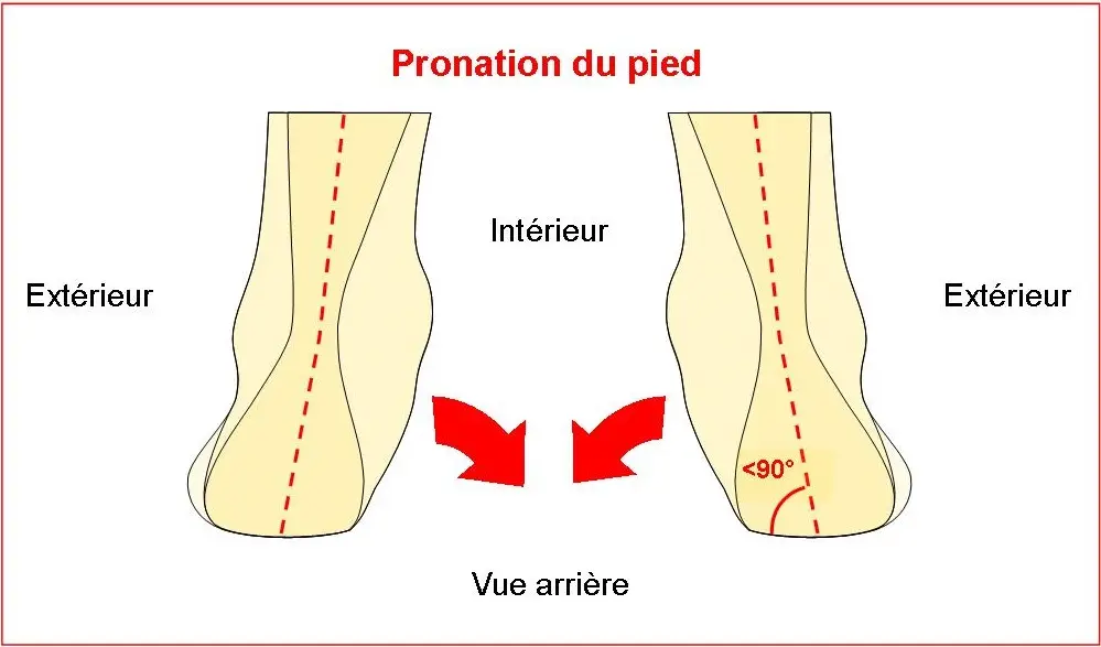 Understanding Foot Pronation Syndrome: Mechanisms, Risk Factors and ...