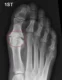 hallux-rigidus-1