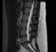 lumbar-disc-disease-extrusion