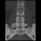 lumbosacral-transitional-vertebra-type-ia