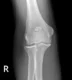 osteochondritis-dissecans-of-the-elbow-and-synovial-osteochondromatosis-1-1-1