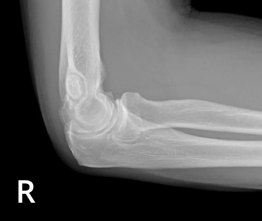 osteochondritis-dissecans-of-the-elbow-and-synovial-osteochondromatosis ...