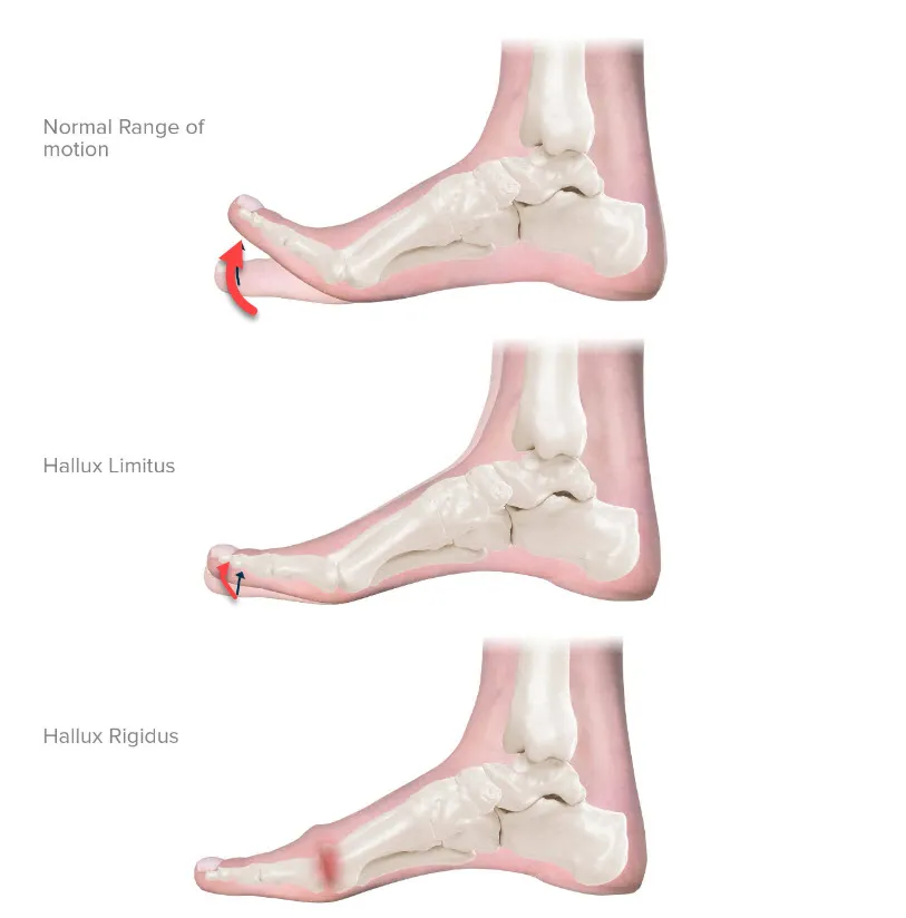 Hallux limitus, rigitus | OsteoMag