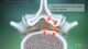 Miniature de la vidéo : Lumbar Stenosis. Reasons