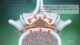 Miniature de la vidéo : Lumbar Stenosis. Symptoms