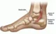 posterior-tibial-tendonitis-foot