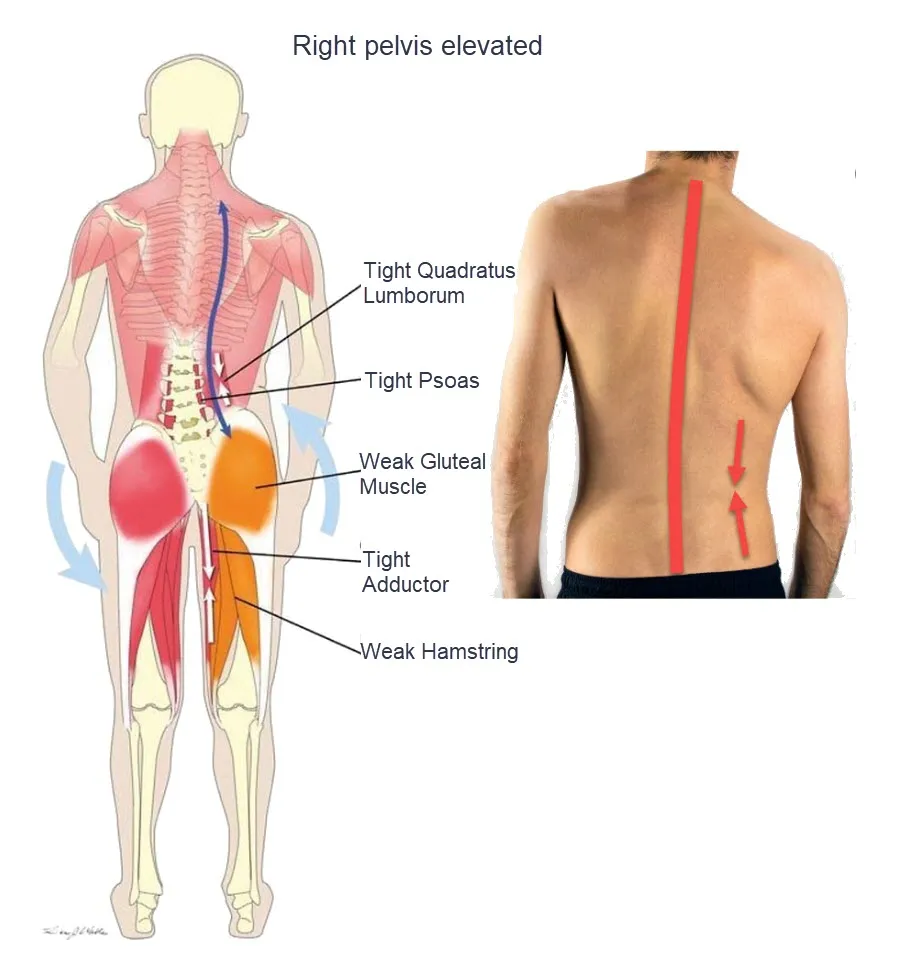 Understanding And Managing Quadratus Lumborum Myofascial Syndrome With Osteopathy Osteomag 8666