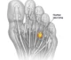 morton__neuroma-1