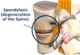 spondylosis