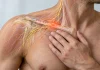 Neuropathie du nerf supraclaviculaire : douleur persistante après fracture ou chirurgie de la clavicule
